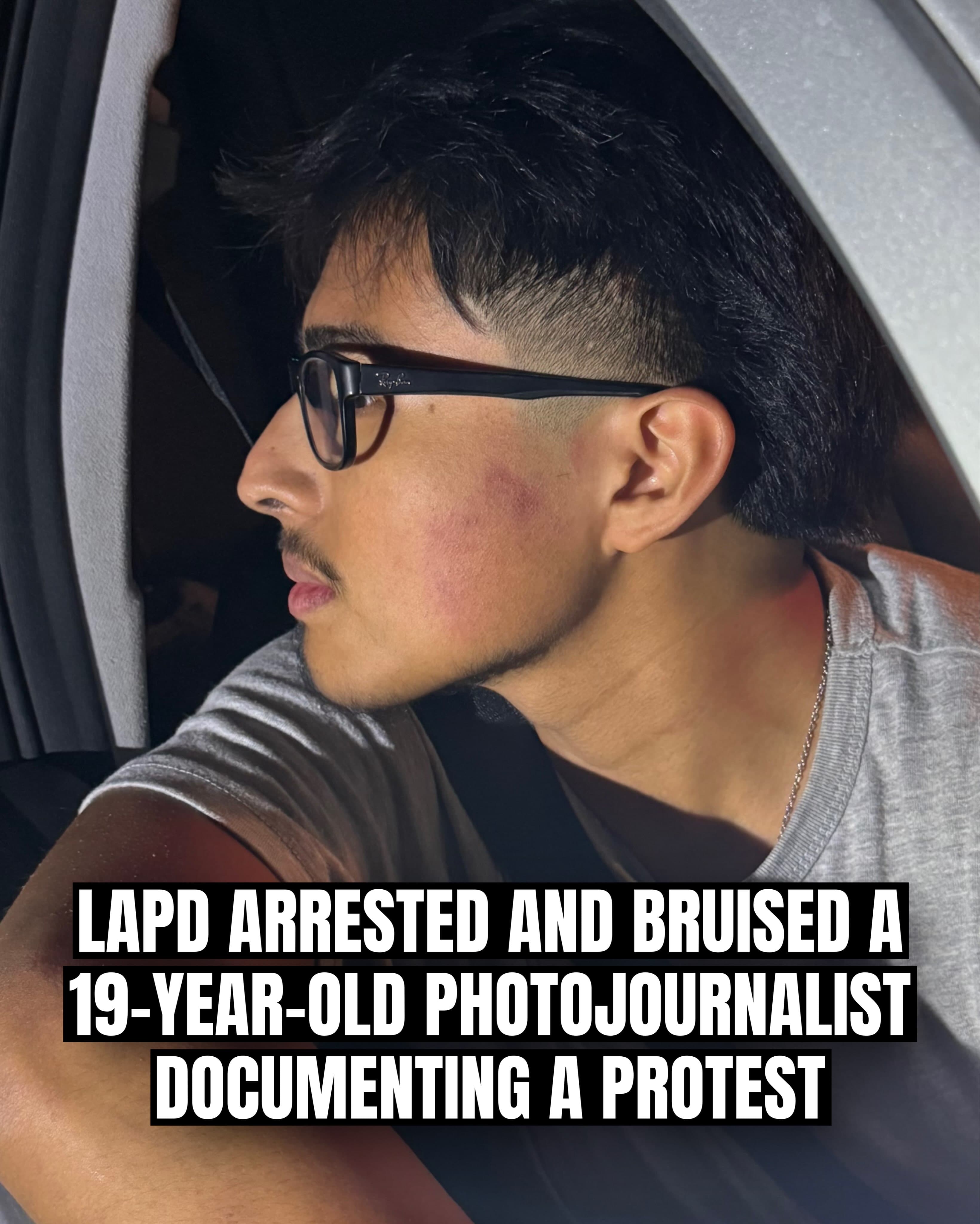 LAPD arrests and bruises 19-year-old photojournalist covering ICE protest